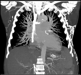 Stent in SVC - CTisus CT Scan