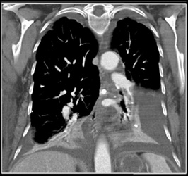 Pulmonary Embolism - CTisus CT Scan