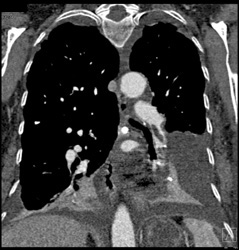 Pulmonary Embolism - CTisus CT Scan