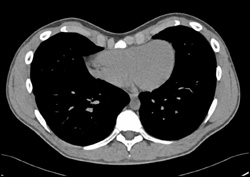 Pectus Deformity in 3D - CTisus CT Scan