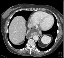 Hiatal Hernia as Mediastinal Mass - CTisus CT Scan