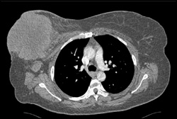 Breast Cancer With Axillary Nodes - CTisus CT Scan