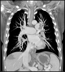 Pulmonary Embolism - CTisus CT Scan