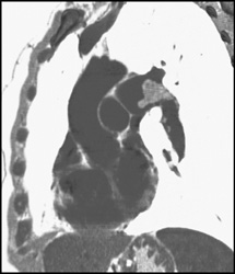 Pulmonary Embolism - CTisus CT Scan