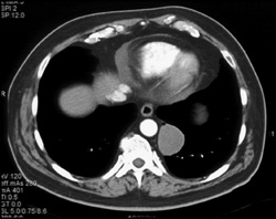 Neurogenic Tumor - CTisus CT Scan