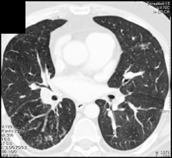 Tumor in Right Hilum - CTisus CT Scan