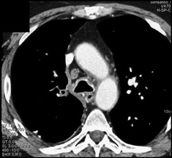 Tumor Encases the Right Pulmonary Artery - CTisus CT Scan