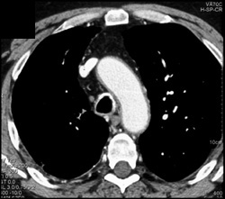 Bronchiectasis Right Upper Lobe - CTisus CT Scan