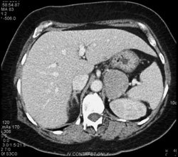 Breast Cancer With Adrenal Metastases - CTisus CT Scan