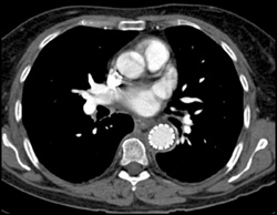 Stent Used for Repair of Descending Aortic Aneurysm - CTisus CT Scan