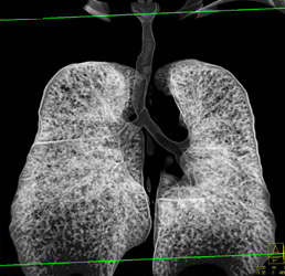 Stenosis in Trachea - CTisus CT Scan