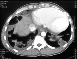 Poor Cardiac Function With Reflux Into IVC and Hepatic Veins - CTisus CT Scan