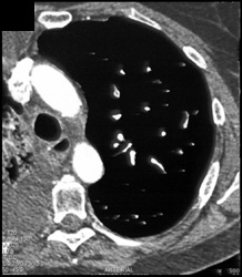 Pulmonary Embolism - CTisus CT Scan