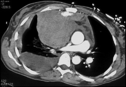 Mediastinal Hematoma With Active Bleeding - CTisus CT Scan