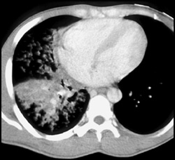 Swollen Cocaine Spoon in Right Lower Lobe - CTisus CT Scan