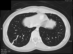 Pulmonary Arteriovenous Malformations (AVMs) - CTisus CT Scan