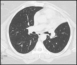 Tumor in Lingular Bronchus With Collapse-dx-carcinoid - CTisus CT Scan