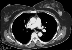 Nodule in Left Breast - CTisus CT Scan