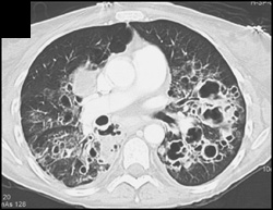 Cystic Fibrosis - CTisus CT Scan