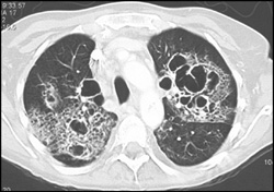 Cystic Fibrosis - CTisus CT Scan