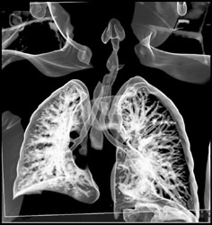 S/P Tracheal Reconstruction - CTisus CT Scan