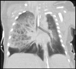 Cystic Adenomatoid Malformation - CTisus CT Scan