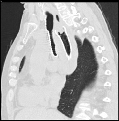 Te Fistulae Due to Cancer With Stents in Place - CTisus CT Scan