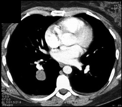 Carcinoid Tumor - CTisus CT Scan