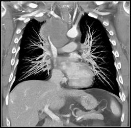 Lung Cancer With SVC Encasement and Liver Metastases - CTisus CT Scan