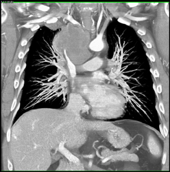 Small Cell Carcinoma With SVC Encasement - CTisus CT Scan