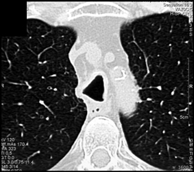 Wegener's Granulmoatosis - CTisus CT Scan