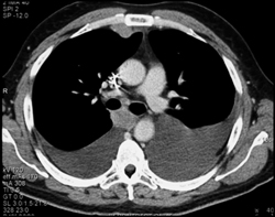 Internal Mammary Nodes in Lymphoma - CTisus CT Scan