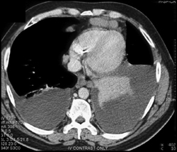 Paracardiac Nodes- Lymphoma - CTisus CT Scan