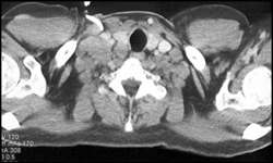 Lymphoma - CTisus CT Scan