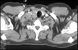 Lymphoma - CTisus CT Scan