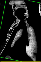 Tracheal Stenosis - CTisus CT Scan