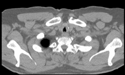 Tracheal Stenosis - CTisus CT Scan