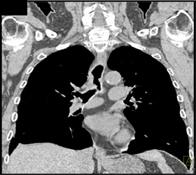 Carcinoma of the Trachea - CTisus CT Scan