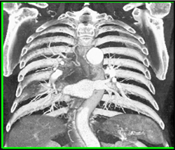 Tumor Encases the Right Hilum - CTisus CT Scan