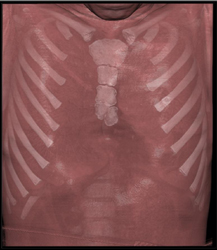 Pectus Deformity - CTisus CT Scan