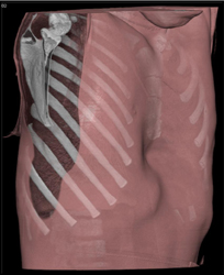 Pectus Deformity - CTisus CT Scan