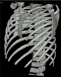 Pectus Deformity - CTisus CT Scan