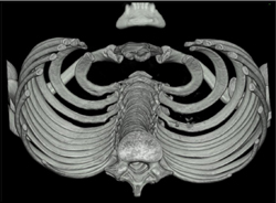 Pectus Deformity - CTisus CT Scan