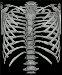 Pectus Deformity - CTisus CT Scan