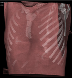 Pectus Deformity - CTisus CT Scan