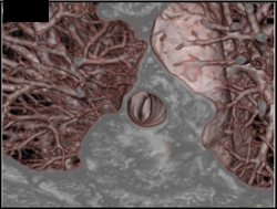 Virtual Endoscopy - CTisus CT Scan