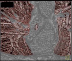 Carcinoma Infiltrates the Trachea - CTisus CT Scan