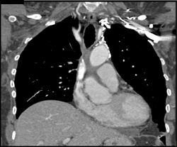 Tracheal Cancer With Fistulae to the Esophagus - CTisus CT Scan