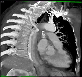 Prominent Azygos Arch - Chest Case Studies - CTisus CT Scanning