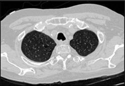 Tracheal Cancer - CTisus CT Scan